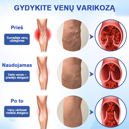 Veinhealing™ purškalas varikozinėms venoms gydyti🌱(👩‍⚕️rekomenduoja kardiologai)